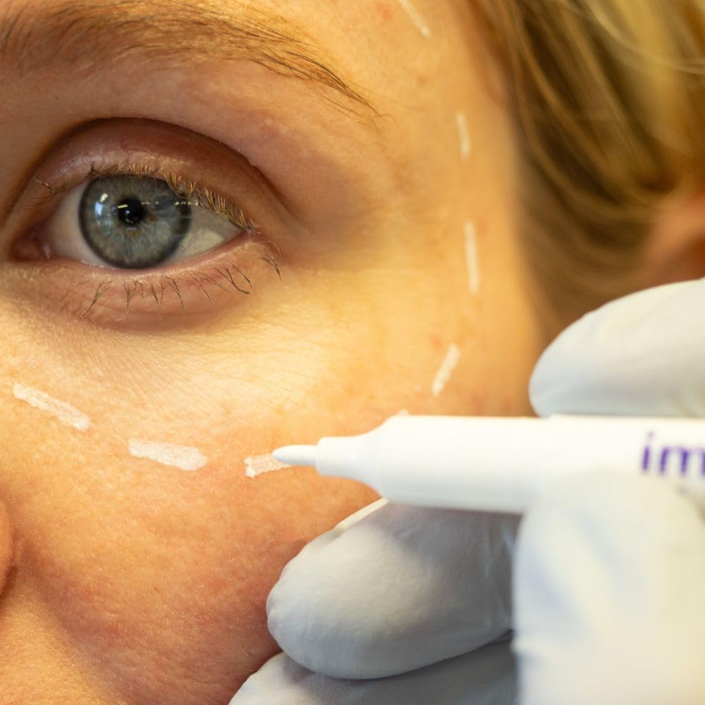 Skin Markers &ndash; Box of 10 Mini Marker Pens for Dermal Filler, Tox & Aesthetic Marking &ndash; Easily Removed with Alcohol or Soap &ndash; Precise, Visible Skin Mapping (WHITE) &ndash; Imatec (White, White) image number 1