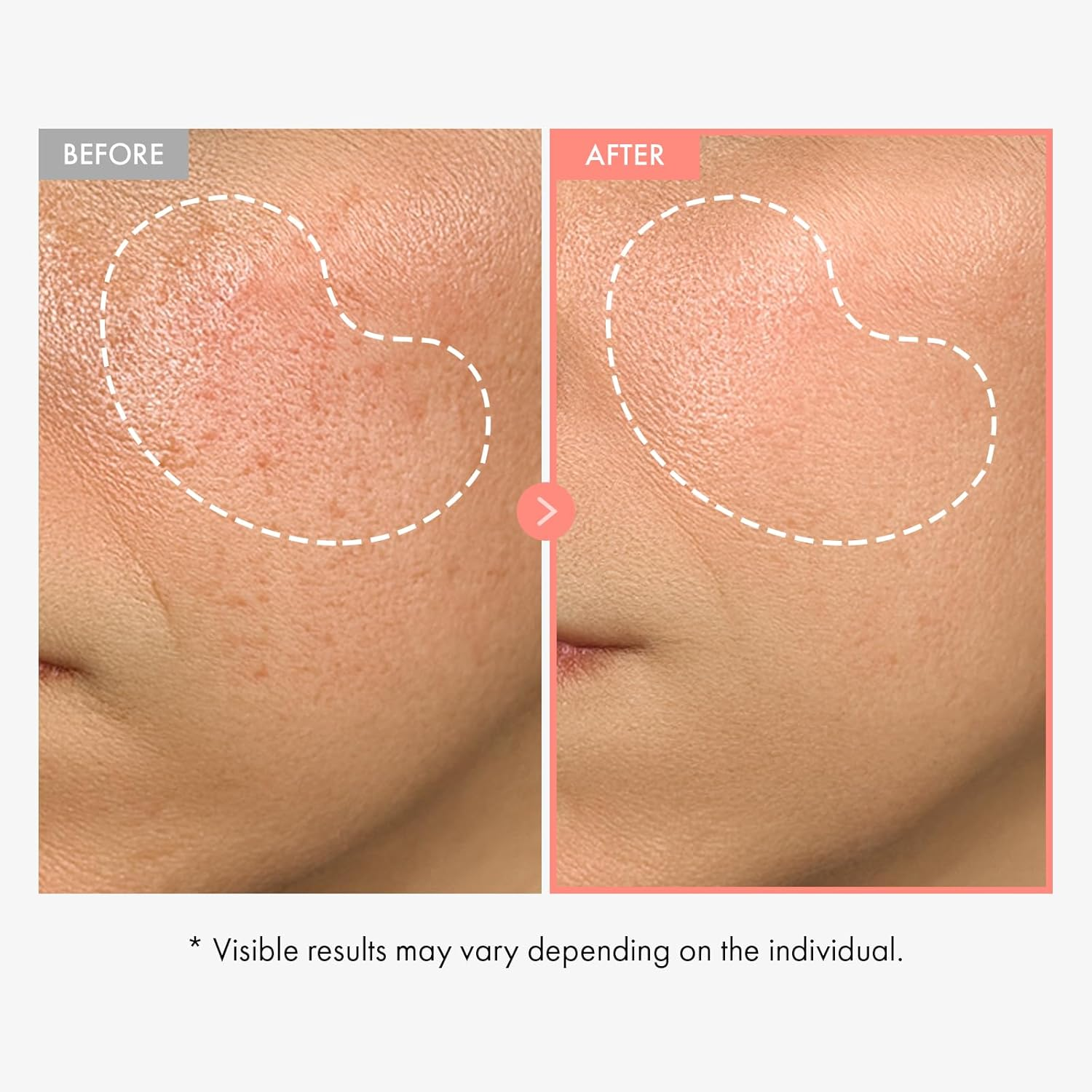 TOSOWOONG Peach 80 Niacin Serum, 5% Niacinamide, Alpha-Arbutin, Vitamin B12, Glass Skin, Hydrating Face Serum for Dark Spots, Pore Minimizer, Uneven Tone, Dullness, Korean Skincare, 33Ml / 1.11 Fl. Oz. image number 5