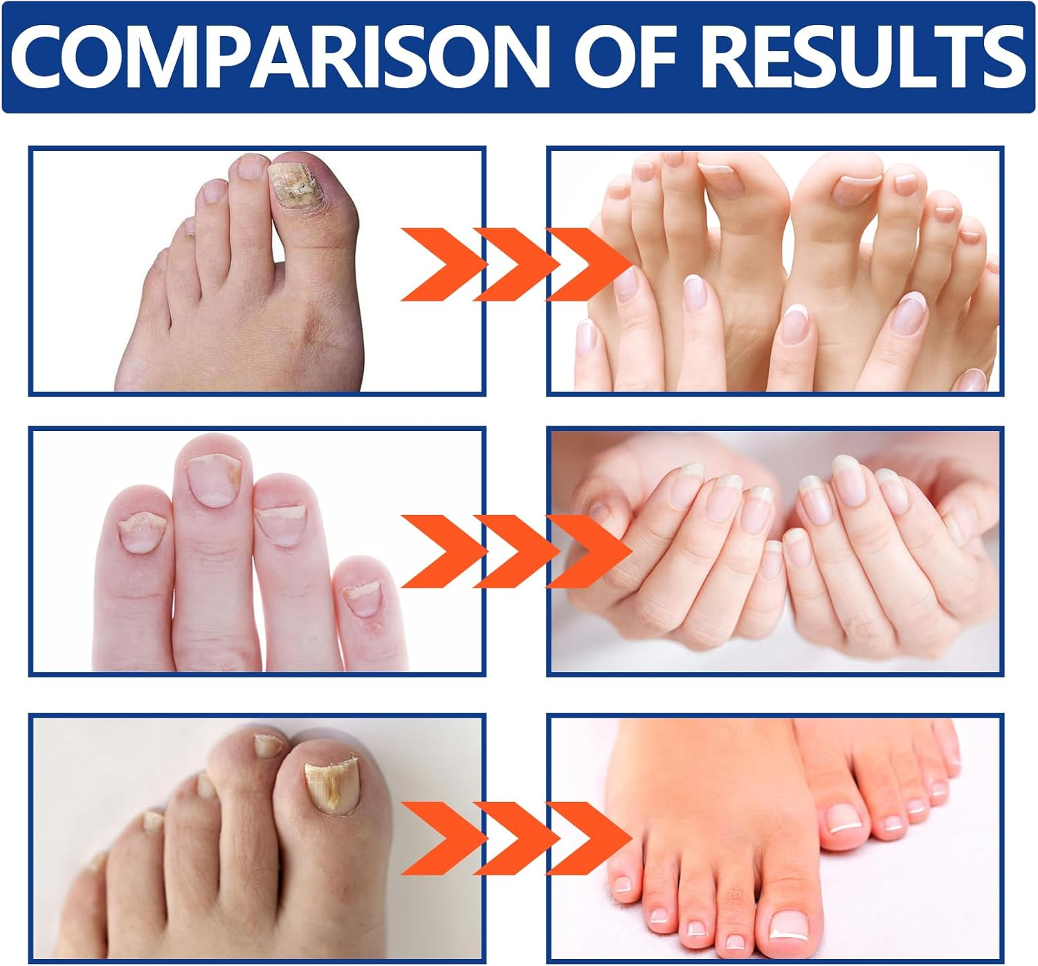 Mingzhe Laser-Nail Device Nail Fungus Cleaning Laser Device Nail Fungus Laser Treatment for Damaged Discolored Thick Toenails & Fingernails image number 6