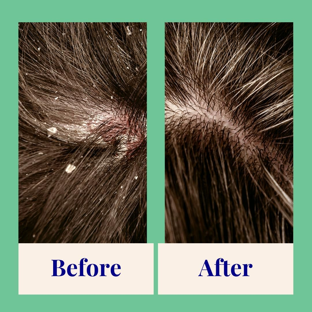 Exfoliating & Balancing Shampoo (Thyme & Tea Tree) 20G Mini Bottle' Specified Cannot Be Used as It Conflicts with the Value 'Exfoliating Foaming Powder Shampoo for Dandruff | 20X Washes | Vegan, Eco-Friendly, Tea Tree, Salicylic Acid 0.7 Mini Aluminum Bottle image number 6