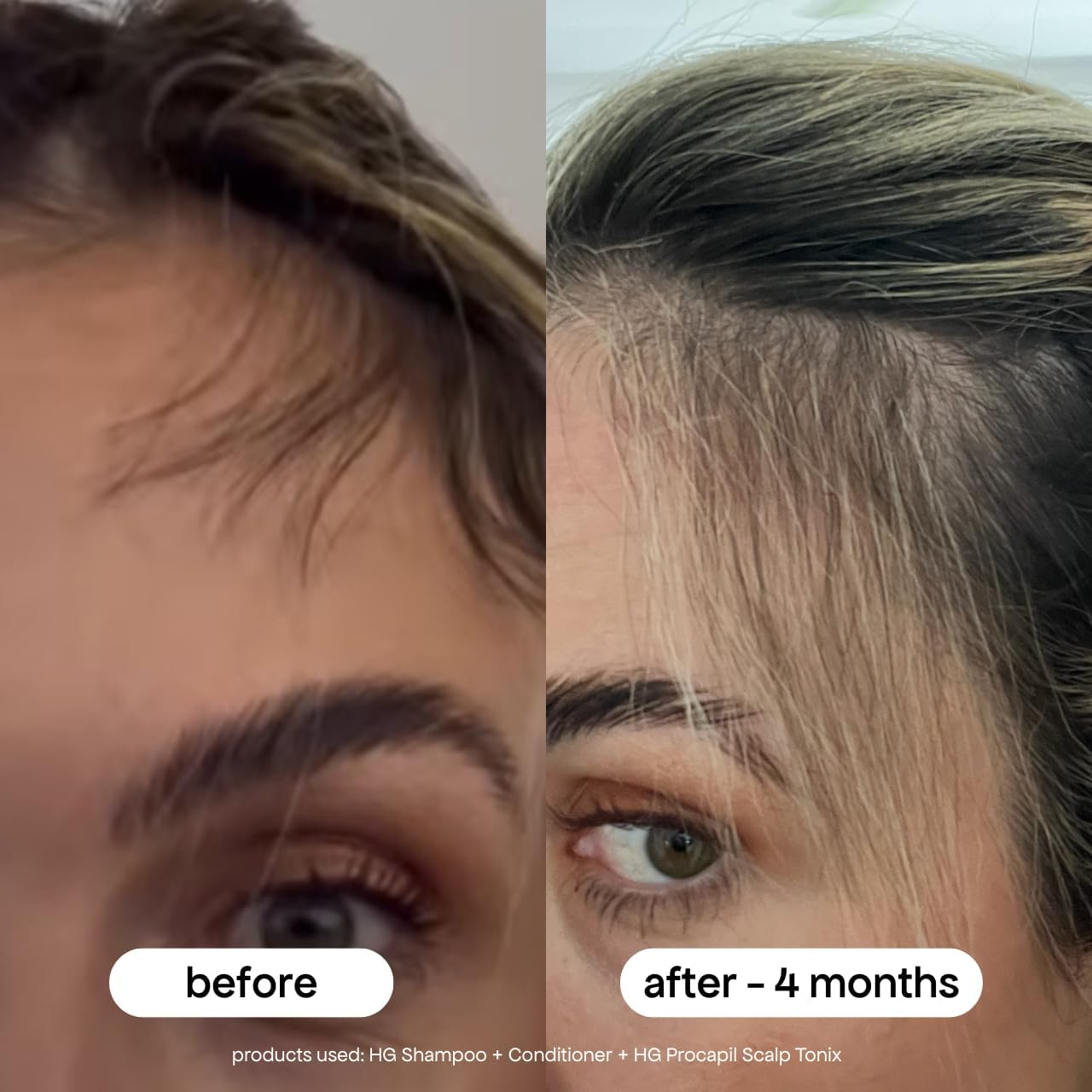 Bondiboost Procapil Hair Tonic 4.23 Fl Oz - Leave-In Treatment for Thinning Hair - Reduce Hair Fall + Increase Hair Density - Lightweight Non-Greasy Formula - Vegan/Cruelty-Free - Australian Made image number 1