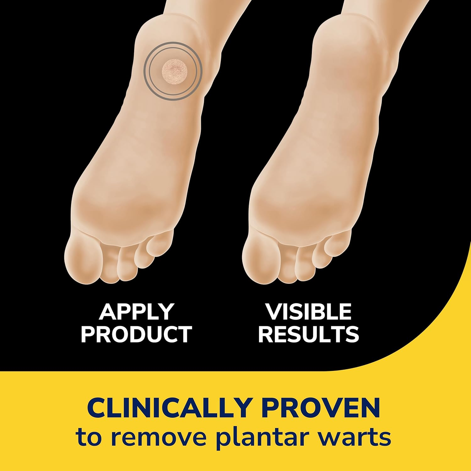 Dr. Scholl&rsquo;S Clear Away Plantar Wart Remover for Feet, 24 Medicated Discs & 24 Cushioning Pads // Maximum Strength without a image number 2