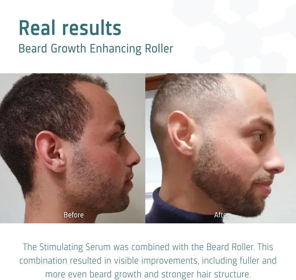 Neofollics Beard Growth Enhancing Roller - 0.5 Mm - Enhances Absorption of the Ingredients Upto 5 Times - Enhances the Efficacy of Topical Products image number 4