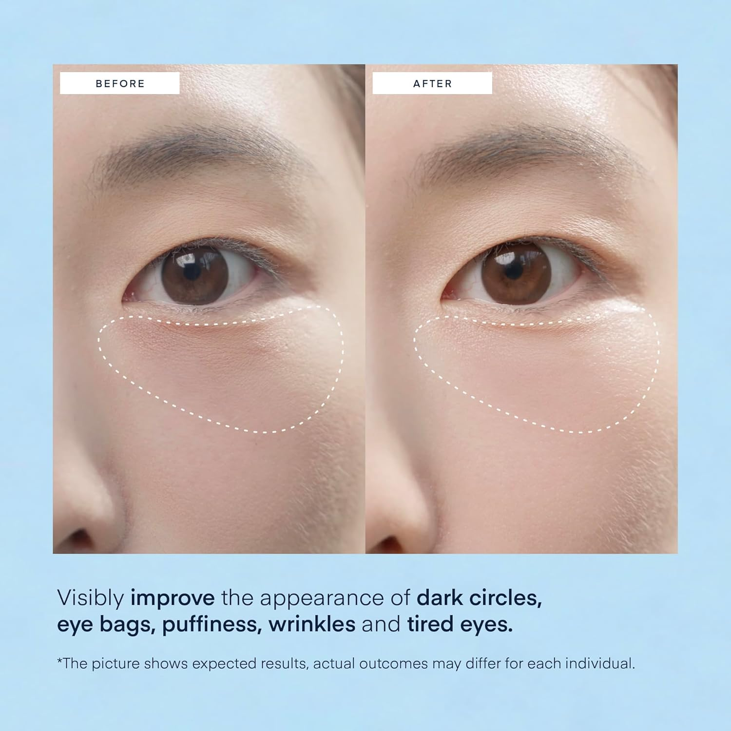 Under Eye Patches Korean Skincare: Caffeine & Hyaluronic Acid Gel under Eye Mask for Puffy Eyes Dark Circles & Eye Bags - Hydrating Anti-Wrinkle, Sensitive Skin Tested, Vegan Cruelty-Free, 30 Pairs image number 3