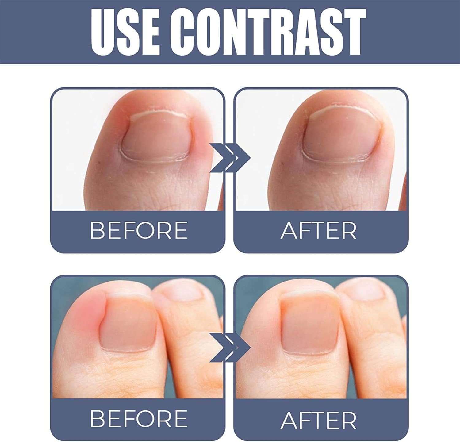 German Toenailcare Removal Paronychia Oil, German Toenailplus anti Paronychia Relief Oil, 2023 New German Toenail Care Removal Paronychia Oil (2PCS) image number 5